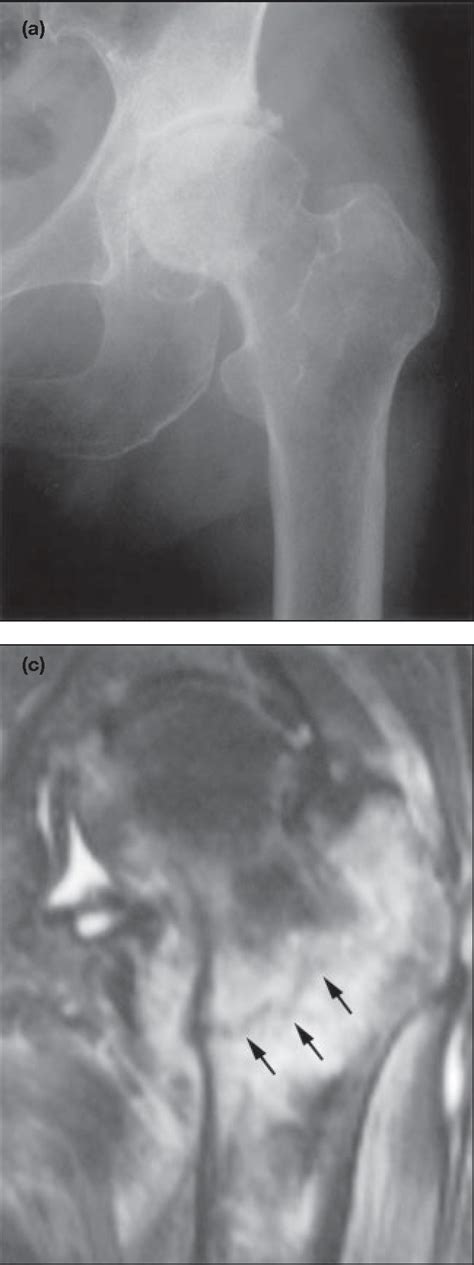 Figure 1 From Early Magnetic Resonance Imaging Of Radiographically