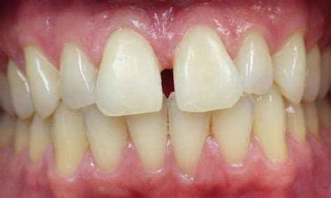 Dentist Duxbury Bonding To Cosmetically Improve Two Front Teeth