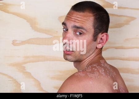 Sun damaged peeling skin on the shoulders and back of a female Stock Photo: 48919793 - Alamy