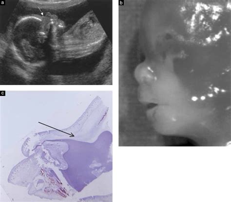 The Nasal Bone In Fetuses With Trisomy Sonographic Versus