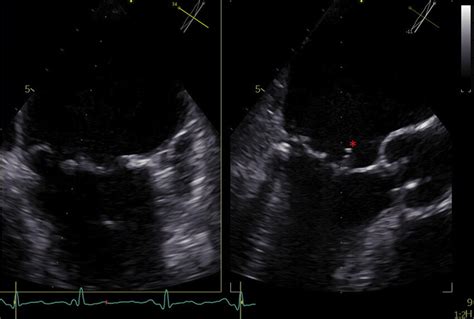 Preoperative Transesophageal Echocardiography Biplane View Download Scientific Diagram