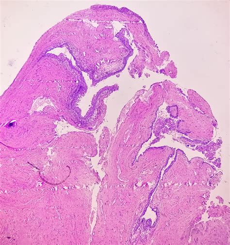 Premium Photo Histology Of Urachal Cyst Photomicrograph Of