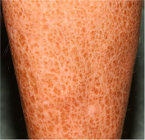 Ichthyosis Vulgaris An Updated Review Jaffar Skin Health