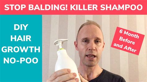 Stop Balding Diy Baking Soda And Acv Shampoo For Hair Regrowth And