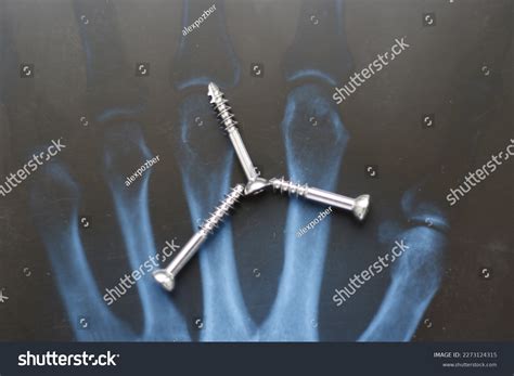 Surgical Plates Osteosynthesis Case Bone Fractures Stock Photo ...