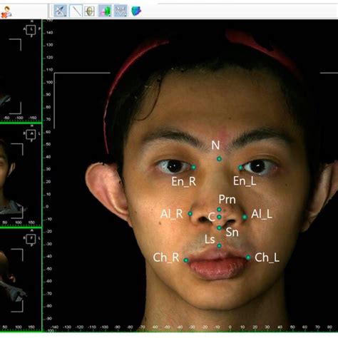 Representation Of Columellar Angle And Columellar Labial Angle