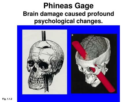 Ppt Phineas Gage Brain Damage Caused Profound Psychological Changes