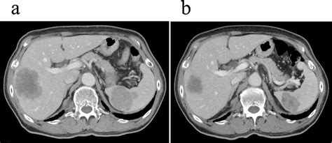 Abdominal Computed Tomography CT Findings A Before Rectal Surgery