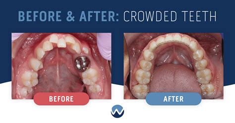 Ways We Can Help With Teeth Crowding Woodhill Dental Specialties