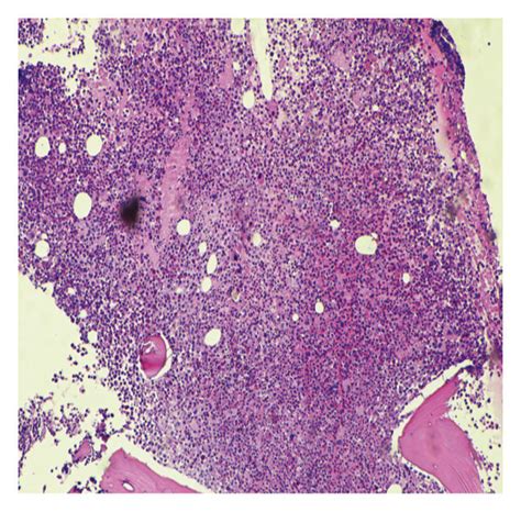 Bone Marrow A B Low Magnification Of The Bone Marrow Aspirate