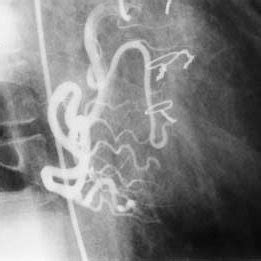 A Postoperative Left Coronary Angiogram Showing Widely Patent