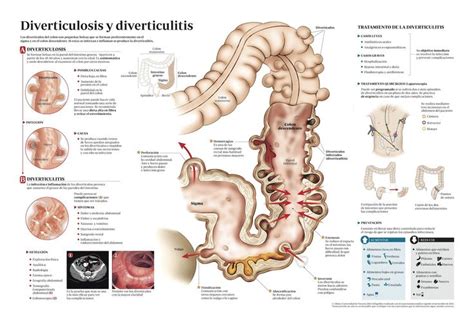 Como Tratar La Diverticulitis Auxiliar De Enfermeria Diverticulos