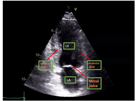 Ultrasound Adult Echocardiography Assessment Protocols And