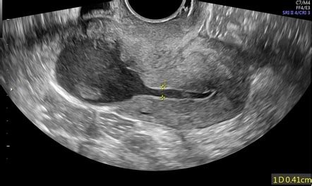 Cesarean Scar Niche With Blood Collection Radiology Case