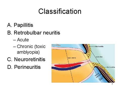 optic neuritis papilledema  optic atrophy dr ajai
