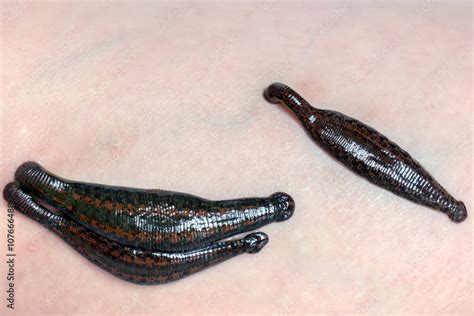 Leeches On Human Skin Hirudotherapy Varicose Stock Photo Adobe Stock