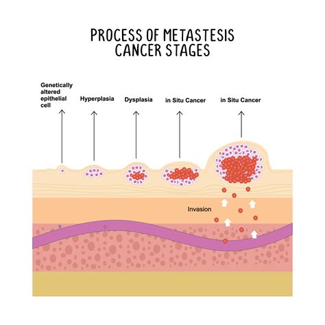 process of metastases cancer stages illustration on white background ...