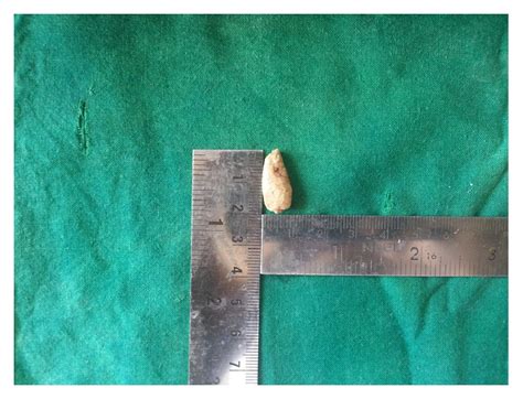 Wharton S Duct Sialolith Of Unusual Size A Case Report With A Review