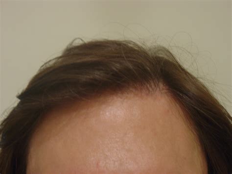 Before & After Photos - Dallas Hair Transplant - Armani Medical