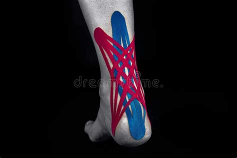 Medical Taping For Calcaneal Spur And Plantar Fasciitis Treatment