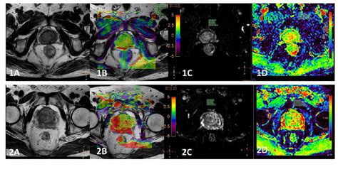 重庆大学附属肿瘤医院影像科张久权团队揭示mri Apt（酰胺质子转移加权成像）定量参数联合血清psa可鉴别前列腺病变良恶性 科室动态 影像科