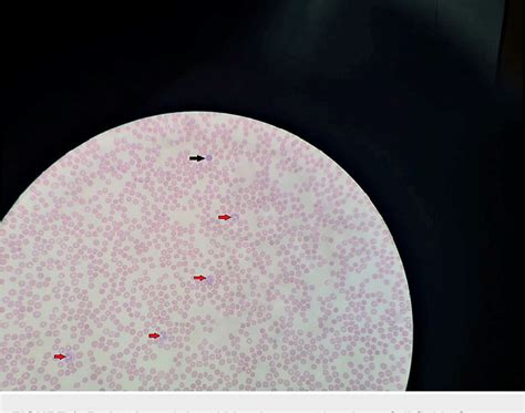 Table From Elderly Patient With Hematological And Neurological