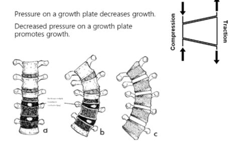 Scoliosis Biomechanics Flashcards Quizlet