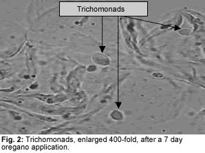 Comment Traiter Trichomonas La R Ponse Est Sur Admicile Fr 20532 Hot