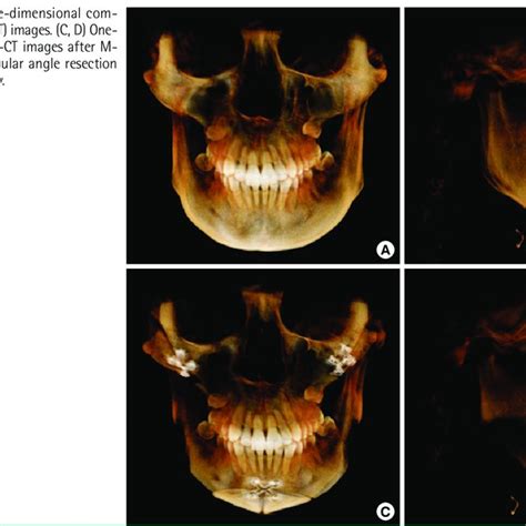 Three Dimensional Computed Tomography Images Download Scientific Diagram