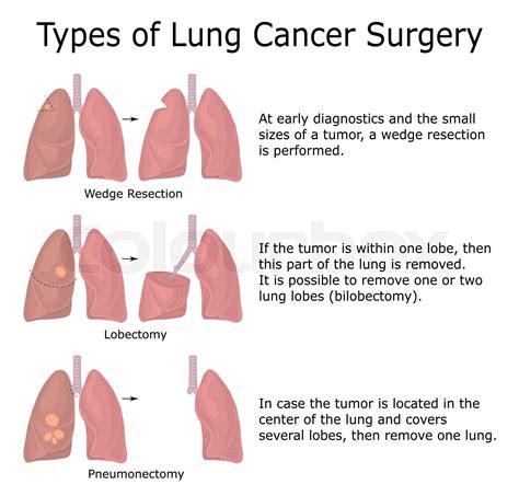 Types of Lung Cancer Surgery | Stock vector | Colourbox