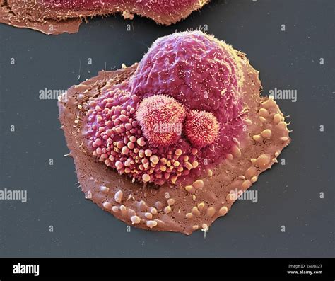 Coloured Scanning Electron Micrograph Sem Of An Ovarian Cancer Cell The Cause Of Ovarian