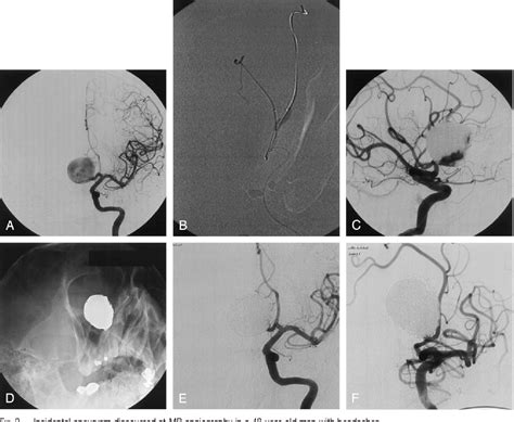 Figure 1 From Selective Endovascular Treatment Of Intracranial