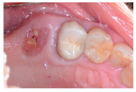 Granulation Tissue Tooth Extraction Site