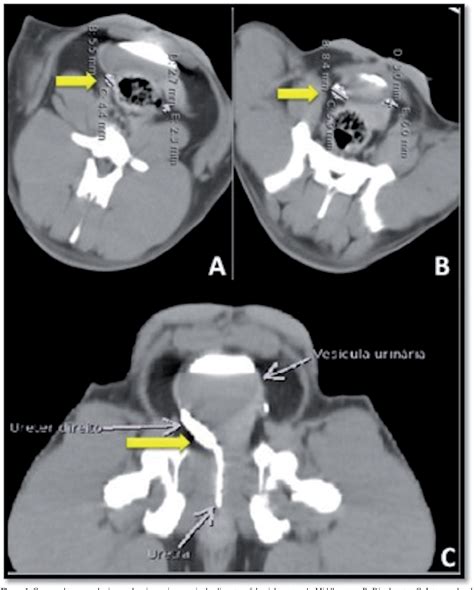 Figure 1 from Ureteral Stent Placement Using a Double J-Catheter in the