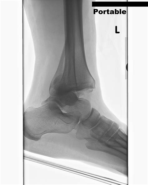 X Rays Of Broken Feet Rome