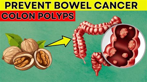 Must Eat Top Foods To Prevent Bowel Cancer And Colon Polyps Daily