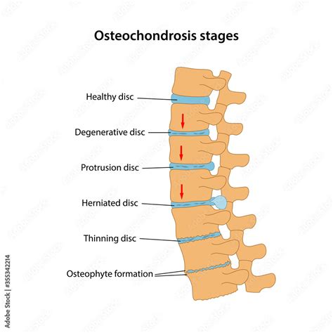 Osteophyte Formation Lumbar Spine