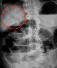 Interpreting An Abdominal X Ray Kub Stepwards