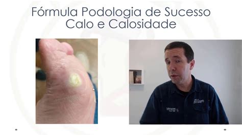 Calo e calosidade parte 3 Fórmula Podologia de Sucesso YouTube