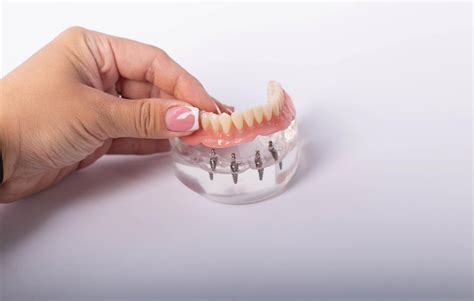 All On 4 Dental Implants In Turkey 2024 Cost Of All On 4 Turkey