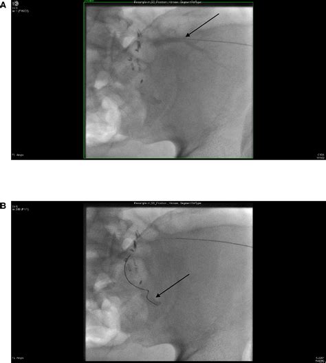 Combined Percutaneous Transrenal And Transfemoral Endovascular