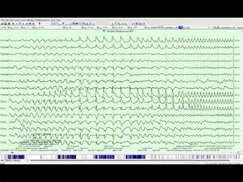 Intracranial Eeg Analysis With High Frequency Display And Ad Hoc Fft