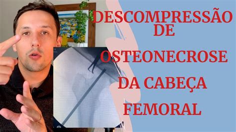 Cirurgia De Descompress O Da Osteonecrose Da Cabe A Femoral Youtube