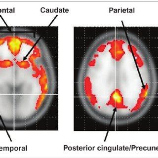 Pdf Visual Assessment Versus Quantitative Assessment Of C Pib Pet