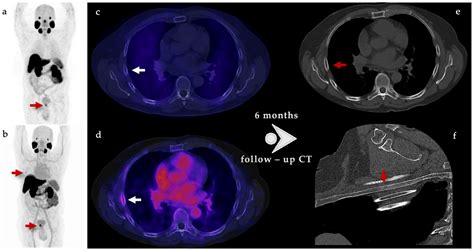 Cancers Free Full Text Diagnostic Performance Of 99mtc Ipsma Spect