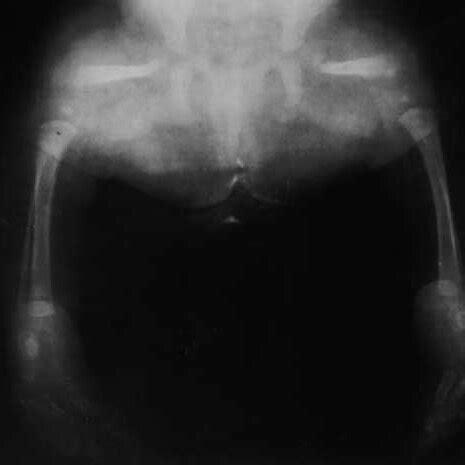 Anteroposterior View Showing Severe Bilateral Hypoplasia Of The