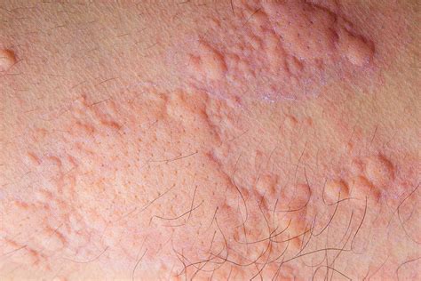 10 Common Rashes Skin Chart