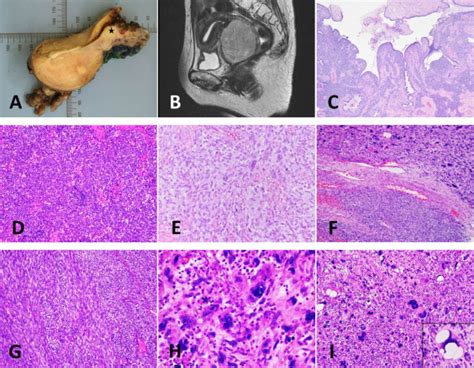 Adult Ntrk Rearranged Spindle Cell Neoplasms Of The Viscera With An