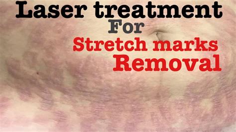 Laser Treatment For Stretch Marks स्ट्रेच मार्क्स को कैसे हटाये