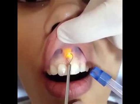 Labial Frenectomy For Upper Lip Tie Youtube